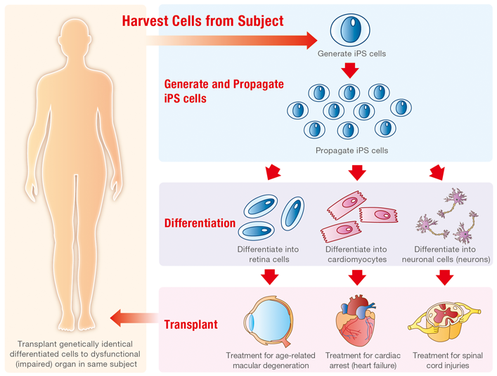 Example of Regenerative Medicine Using Human iPS Cells